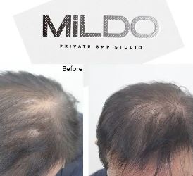 동래두피문신 헤어라인 MiLDO_SMP